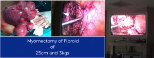 fibroid surgery