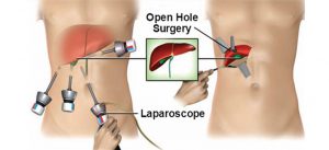 open-cholecystectomy