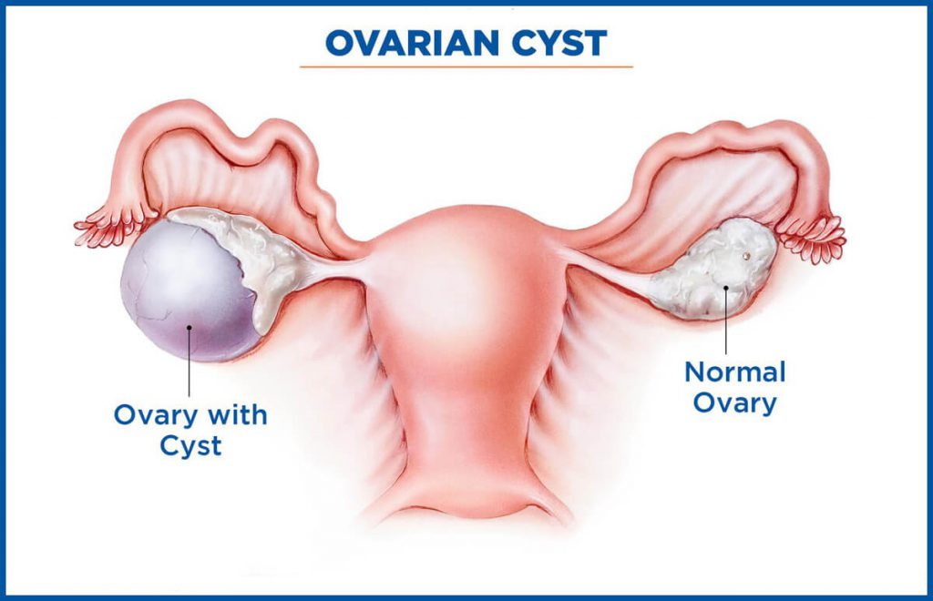 Ovarian Cysts Cysts Treatment Mohali Singla Mediclinic