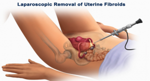 removal-uterine-fibroids