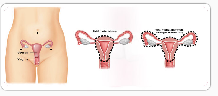 Removal Of Uterus Surgery Mohali Chd Singla Mediclinic