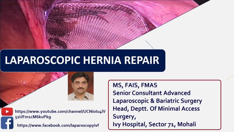 Laparoscopic Hernia Repair Singla Mediclinic