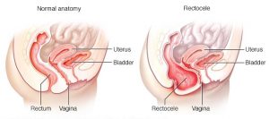 uterine-prolapse-laparoscopic-mesh-repair