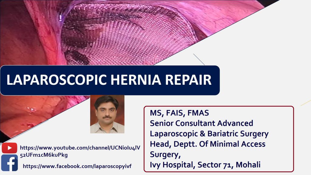 laparoscopic hernia repair | Singla Mediclinic